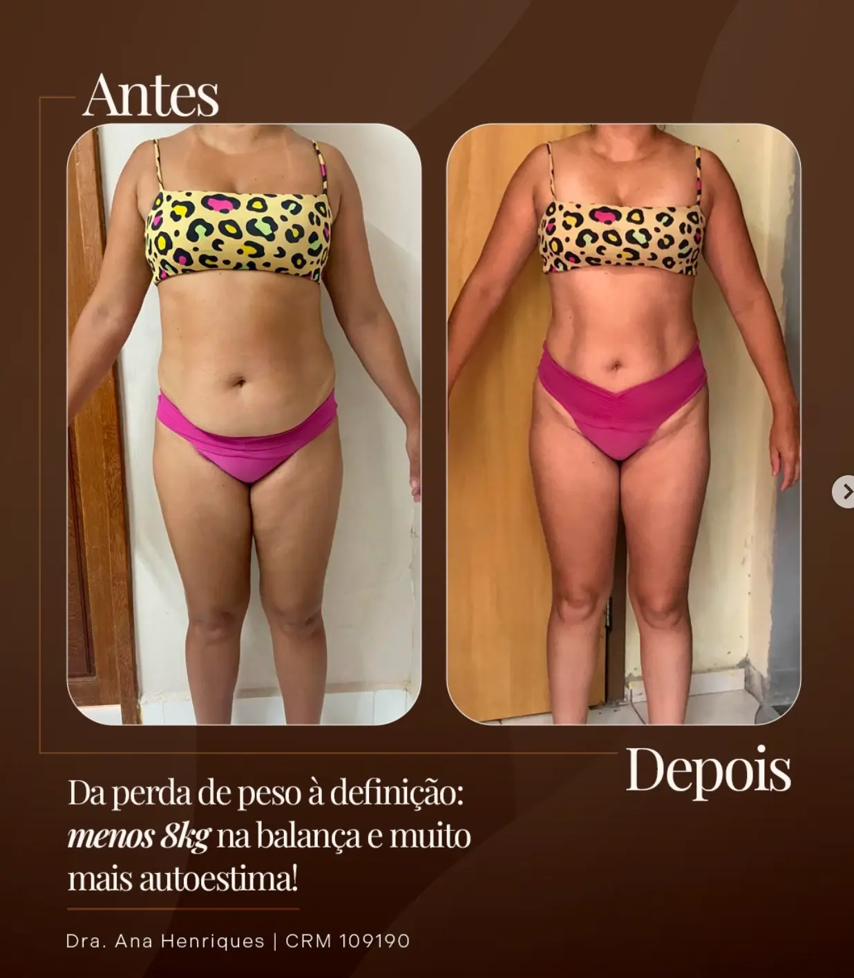 Antes e depois de paciente que perdeu 8kg, com mais definição corporal