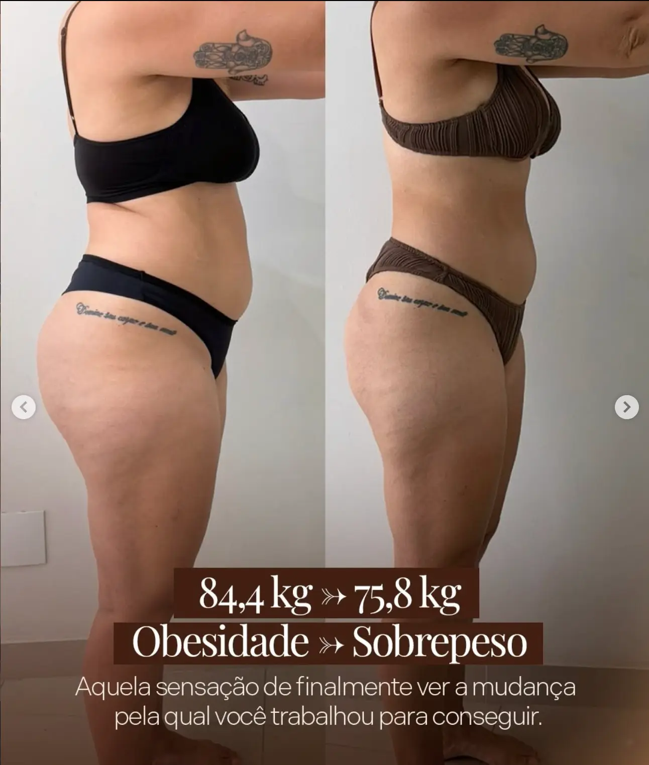 Antes e depois de paciente que saiu de 84,4kg para 75,8kg, de obesidade para sobrepeso